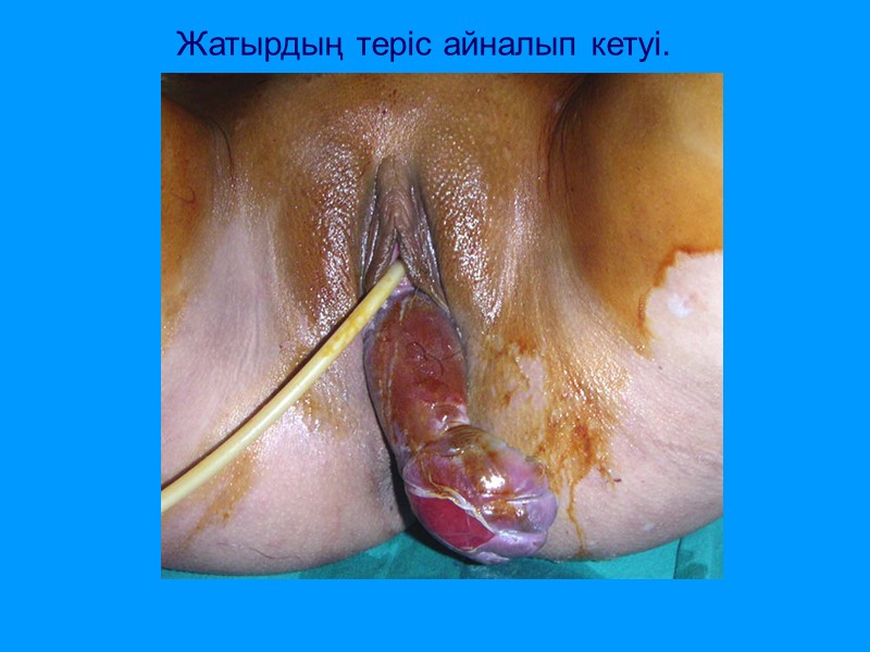 Жатырдың теріс айналып кетуі.